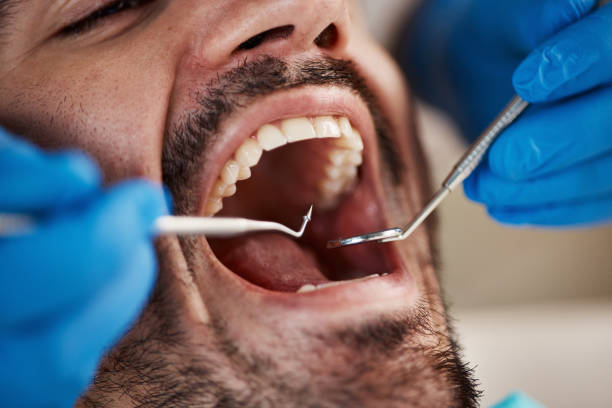 Best Emergency Dentist for Lost Fillings or Crowns in Bath, PA